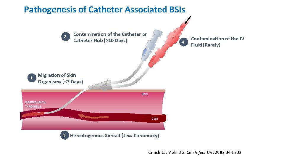 Pathogenesis of Catheter Associated BSIs 2. 1. Contamination of the Catheter or Catheter Hub