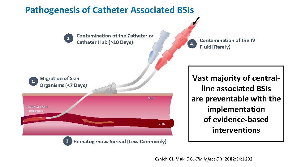Pathogenesis of Catheter Associated BSIs 2. 1. Contamination of the Catheter or Catheter Hub