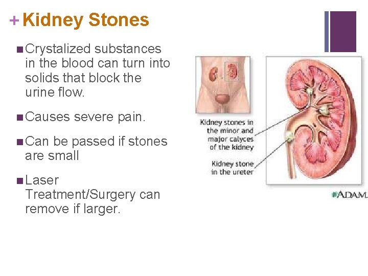 + Kidney Stones n Crystalized substances in the blood can turn into solids that