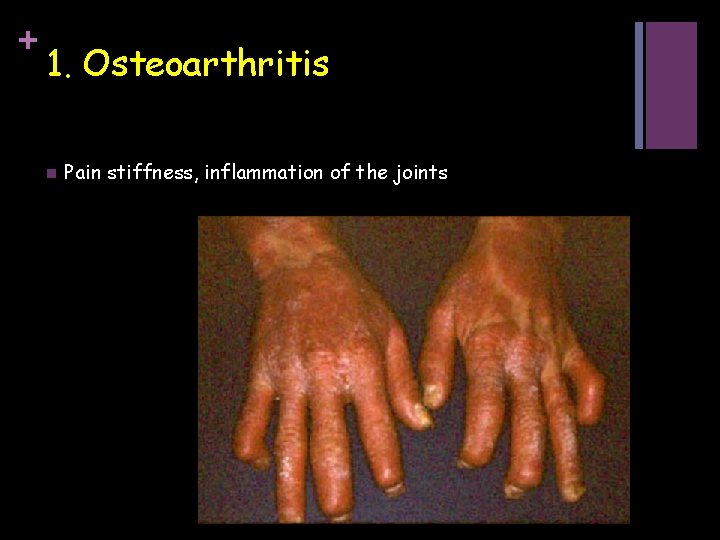 + 1. Osteoarthritis n Pain stiffness, inflammation of the joints 