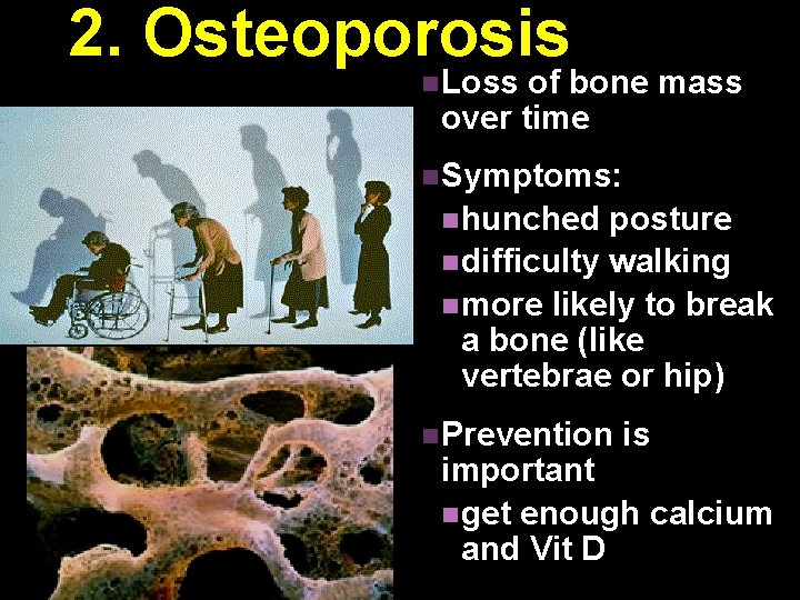 2. Osteoporosis n Loss of bone mass over time n Symptoms: n hunched posture