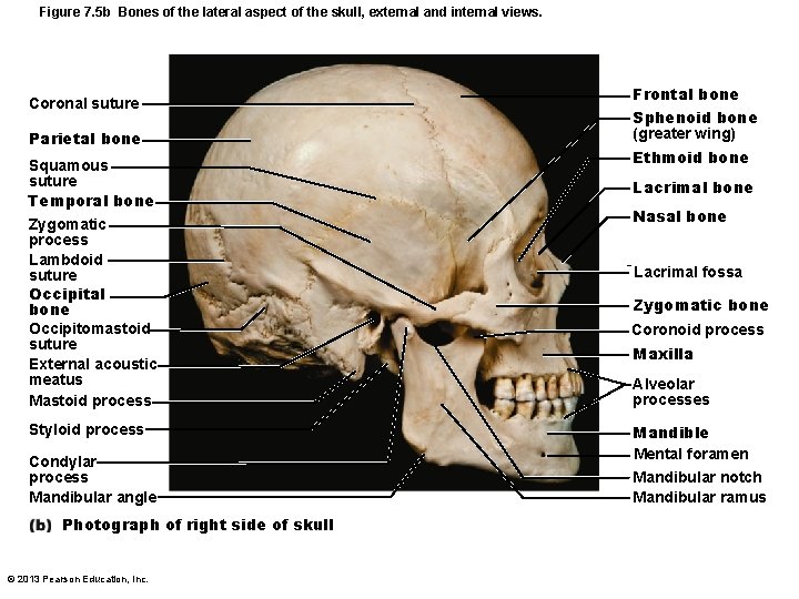 Figure 7. 5 b Bones of the lateral aspect of the skull, external and