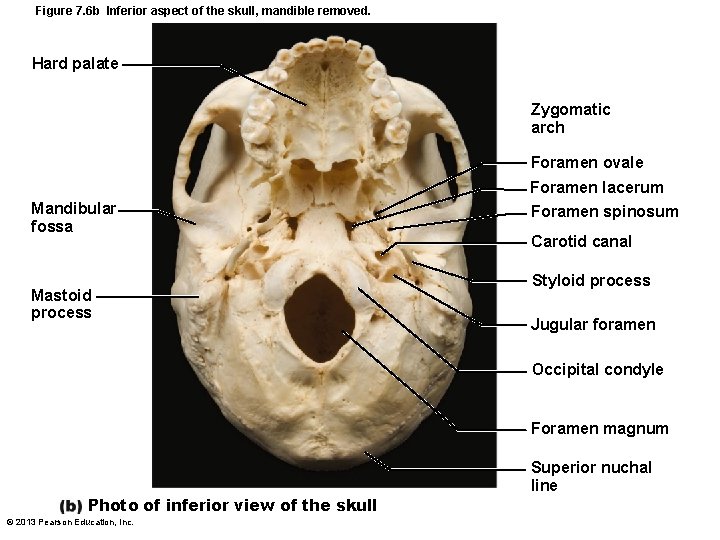 Figure 7. 6 b Inferior aspect of the skull, mandible removed. Hard palate Zygomatic