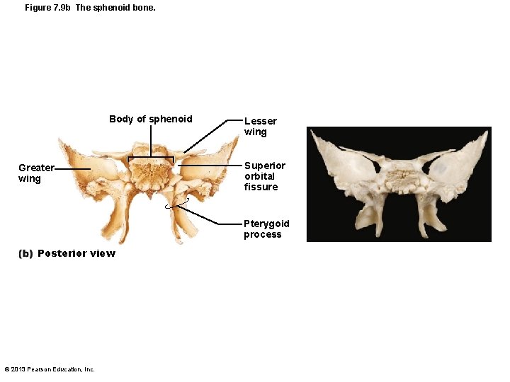 Figure 7. 9 b The sphenoid bone. Body of sphenoid Greater wing Lesser wing