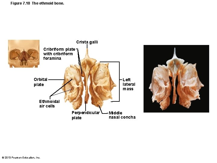 Figure 7. 10 The ethmoid bone. Crista galli Cribriform plate with cribriform foramina Orbital