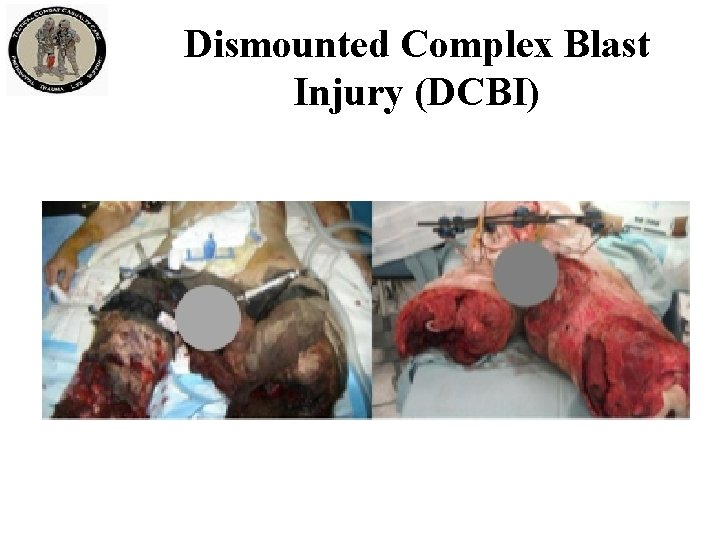 Dismounted Complex Blast Injury (DCBI) 