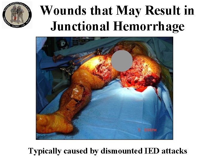 Wounds that May Result in Junctional Hemorrhage Typically caused by dismounted IED attacks 