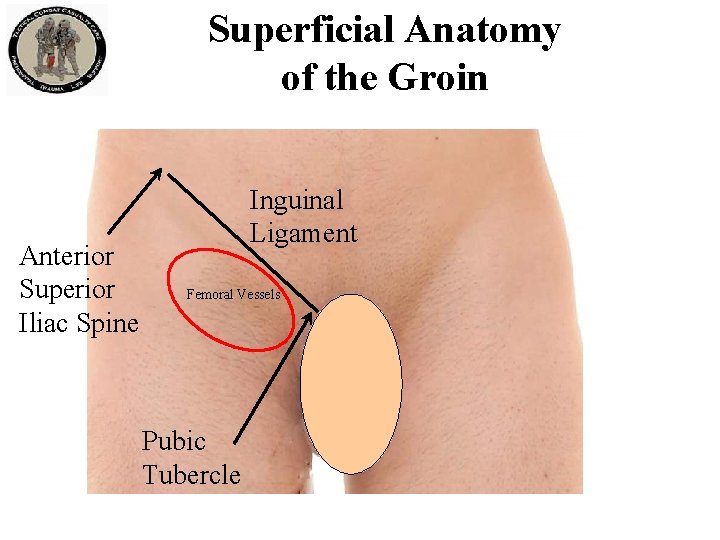 Superficial Anatomy of the Groin Anterior Superior Iliac Spine Inguinal Ligament Femoral Vessels Pubic