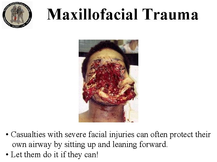 Maxillofacial Trauma • Casualties with severe facial injuries can often protect their own airway