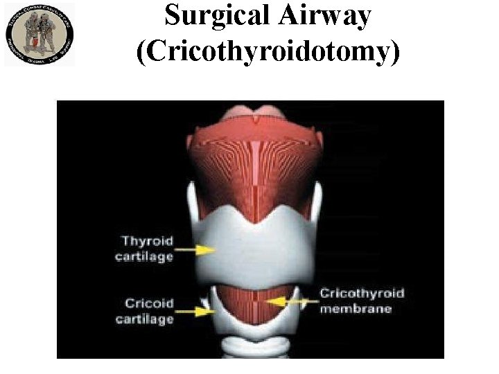 Surgical Airway (Cricothyroidotomy) 