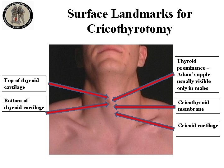Surface Landmarks for Cricothyrotomy Top of thyroid cartilage Thyroid prominence – Adam’s apple usually