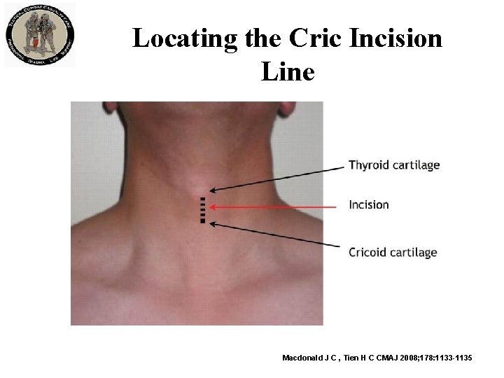 Locating the Cric Incision Line Macdonald J C , Tien H C CMAJ 2008;