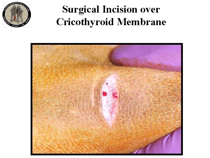 Surgical Incision over Cricothyroid Membrane 