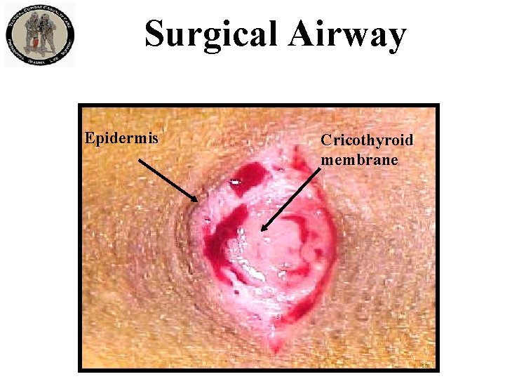 Surgical Airway Epidermis Cricothyroid membrane 