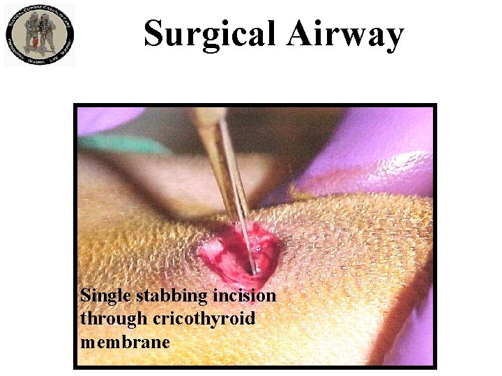 Surgical Airway Single stabbing incision through cricothyroid membrane 