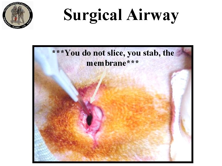 Surgical Airway ***You do not slice, you stab, the membrane*** 