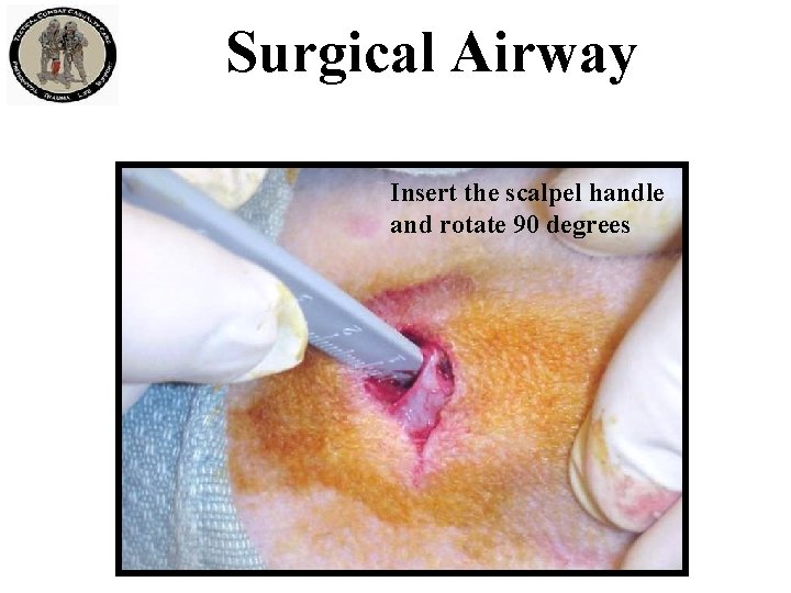 Surgical Airway Insert the scalpel handle and rotate 90 degrees 