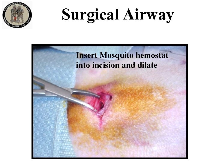Surgical Airway Insert Mosquito hemostat into incision and dilate 
