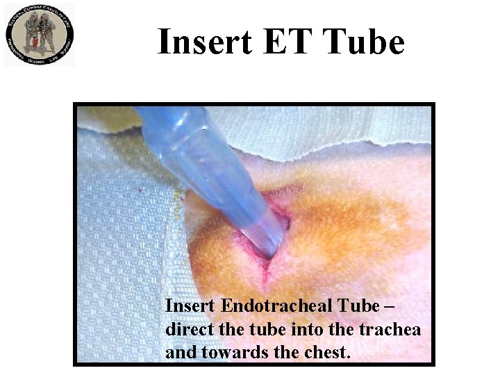 Insert ET Tube Insert Endotracheal Tube – direct the tube into the trachea and