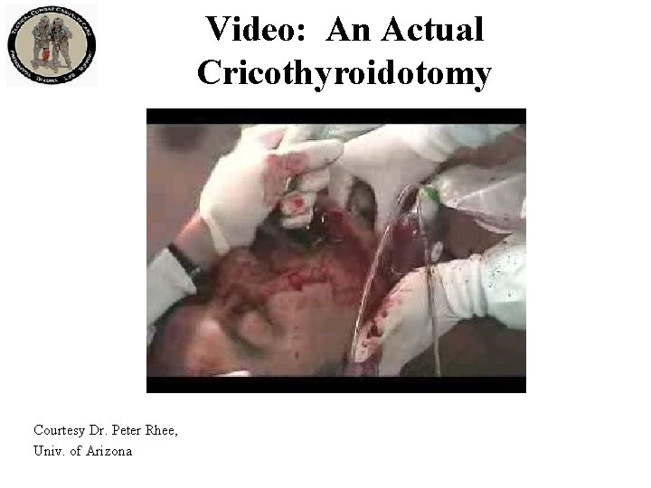 Video: An Actual Cricothyroidotomy Courtesy Dr. Peter Rhee, Univ. of Arizona 