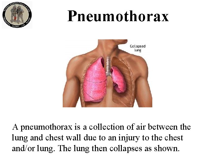 Pneumothorax A pneumothorax is a collection of air between the lung and chest wall