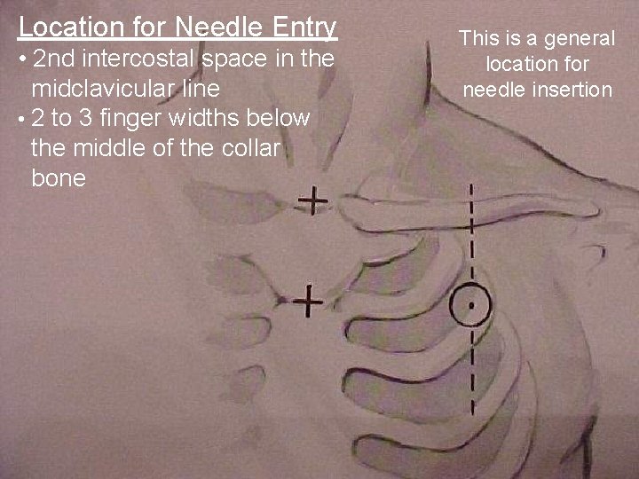 Location for Needle Entry This is afor general Picture of general location • 2