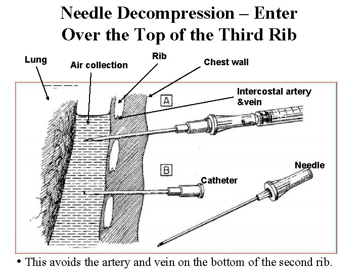 Needle Decompression – Enter Over the Top of the Third Rib Lung Air collection