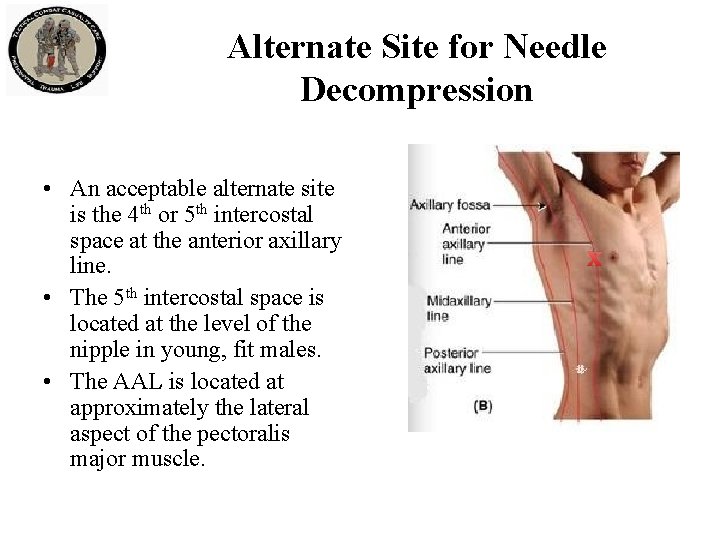 Alternate Site for Needle Decompression • An acceptable alternate site is the 4 th