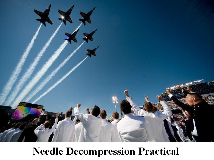 Needle Decompression Practical 