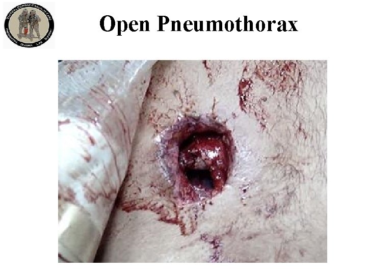 Open Pneumothorax 