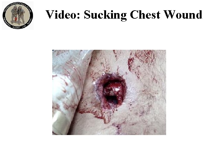 Video: Sucking Chest Wound 