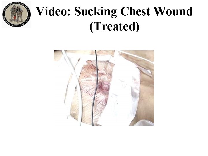 Video: Sucking Chest Wound (Treated) 