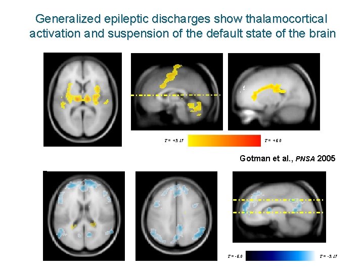 Generalized epileptic discharges show thalamocortical activation and suspension of the default state of the