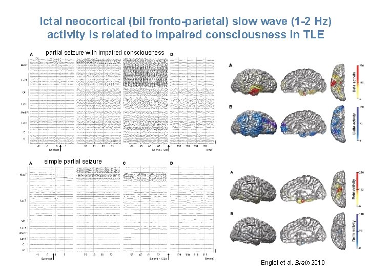 Ictal neocortical (bil fronto-parietal) slow wave (1 -2 Hz) activity is related to impaired