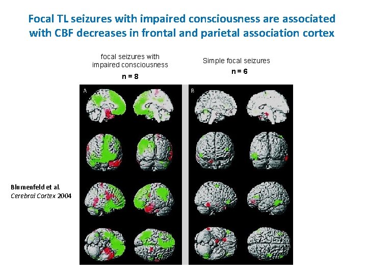 Focal TL seizures with impaired consciousness are associated with CBF decreases in frontal and