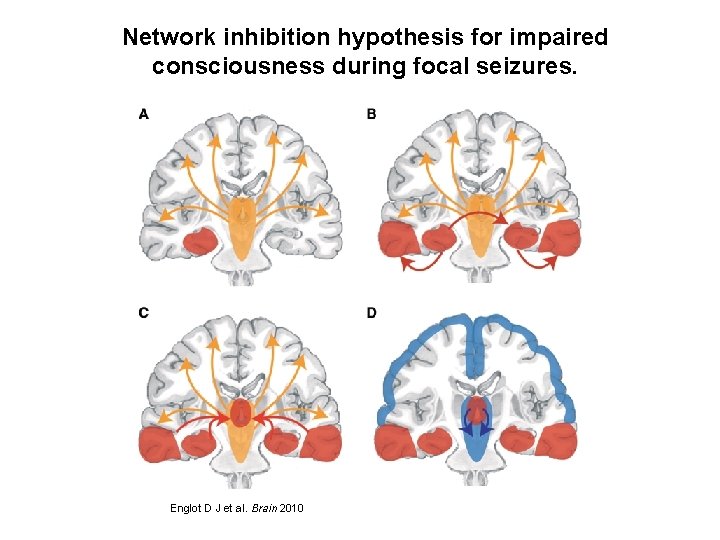 Network inhibition hypothesis for impaired consciousness during focal seizures. Englot D J et al.