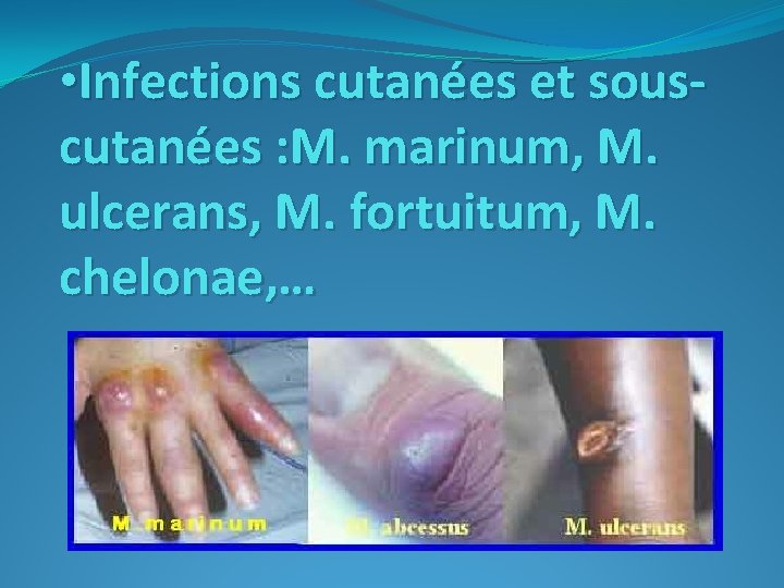  • Infections cutanées et souscutanées : M. marinum, M. ulcerans, M. fortuitum, M.