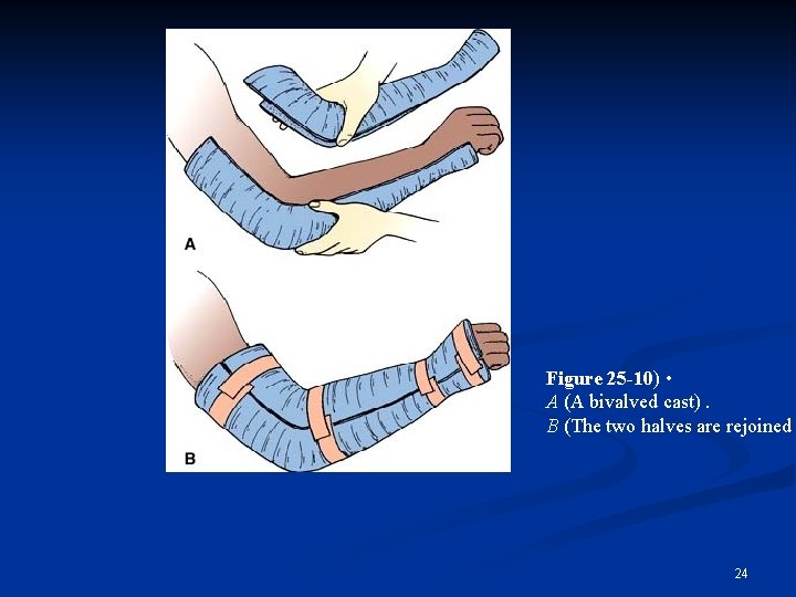 Figure 25 -10) • A (A bivalved cast). B (The two halves are rejoined