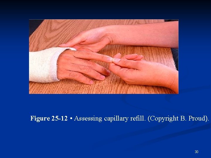 Figure 25 -12 • Assessing capillary refill. (Copyright B. Proud). 30 