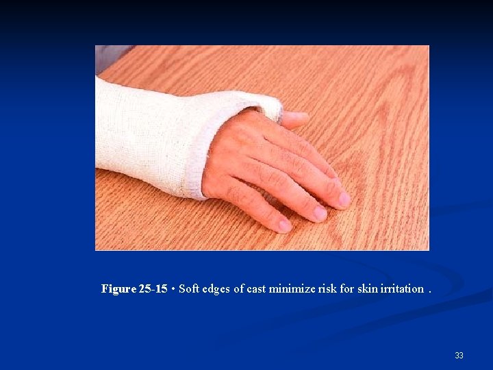 Figure 25 -15 • Soft edges of cast minimize risk for skin irritation. 33