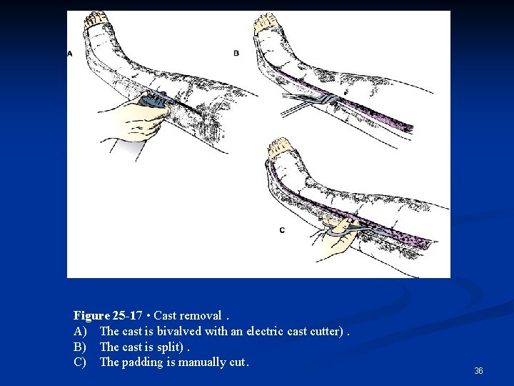 Figure 25 -17 • Cast removal. A) The cast is bivalved with an electric