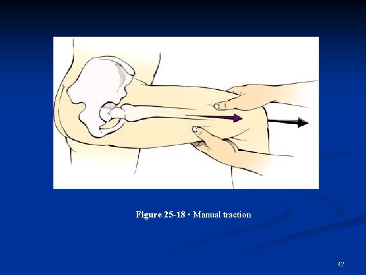 Figure 25 -18 • Manual traction 42 