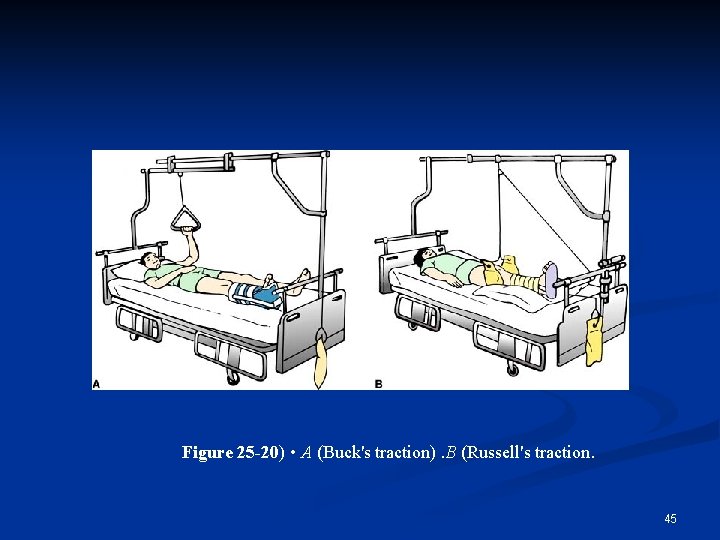 Figure 25 -20) • A (Buck's traction). B (Russell's traction. 45 