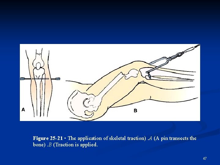 Figure 25 -21 • The application of skeletal traction). A (A pin transects the