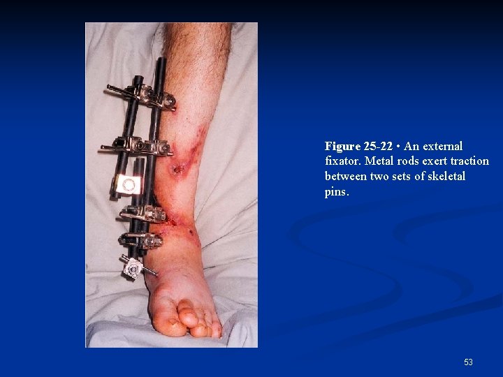 Figure 25 -22 • An external fixator. Metal rods exert traction between two sets