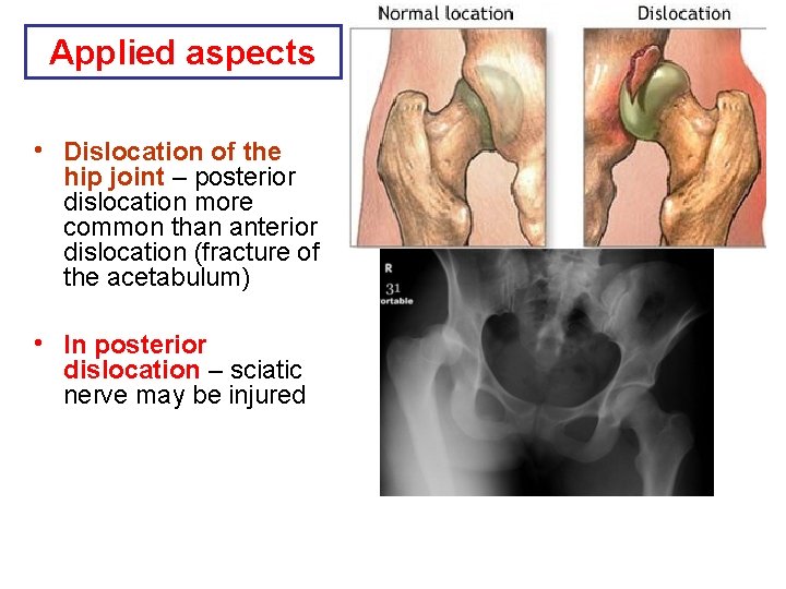 Applied aspects • Dislocation of the hip joint – posterior dislocation more common than