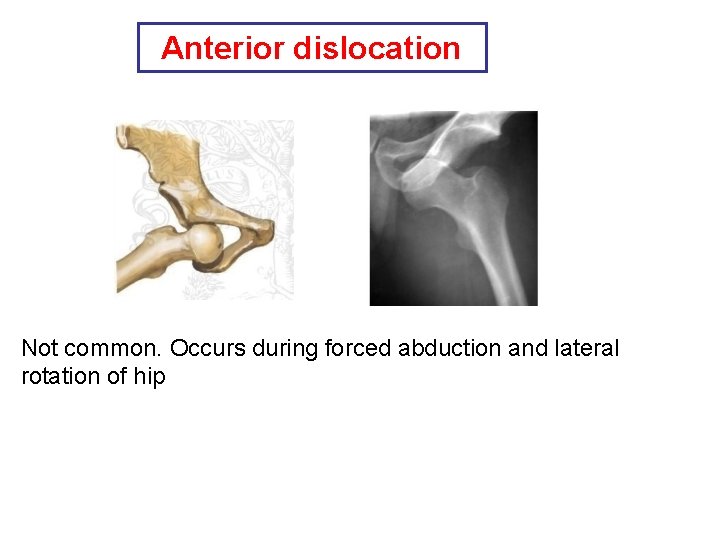 Anterior dislocation Not common. Occurs during forced abduction and lateral rotation of hip 