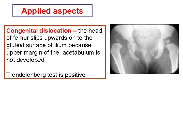 Applied aspects Congenital dislocation – the head of femur slips upwards on to the