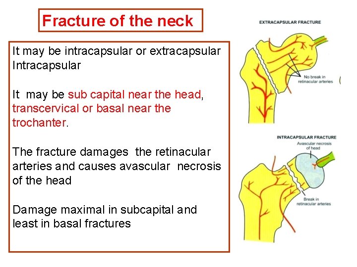 Fracture of the neck It may be intracapsular or extracapsular Intracapsular It may be