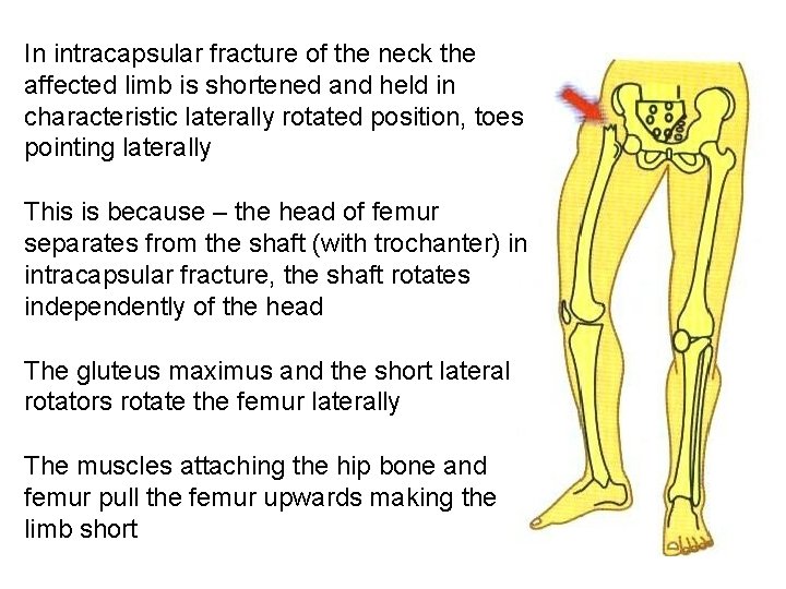 In intracapsular fracture of the neck the affected limb is shortened and held in